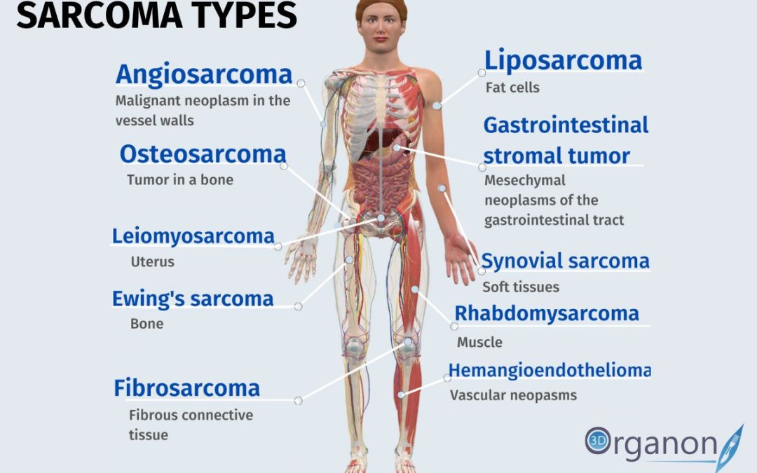 July: Sarcoma Awareness Month