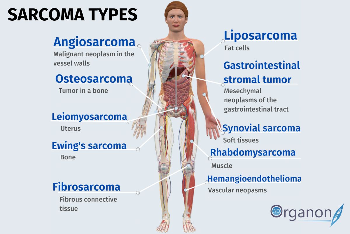 Muscle Sarcoma Liposarcoma Symptoms Causes Stages Diagnosis And